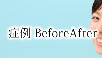 症例BeforeAfter