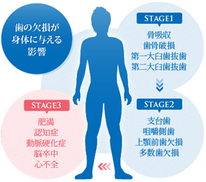 歯の欠損が身体に与える影響