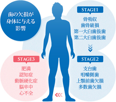 歯の欠損が身体に与える影響